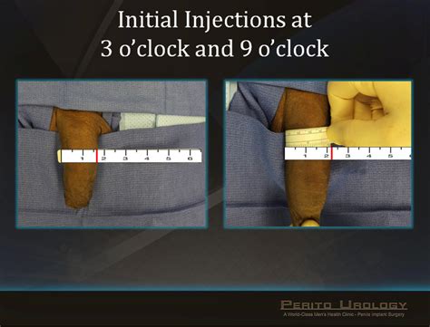 penile injections for girth